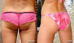 Loose weight and cellulite removal